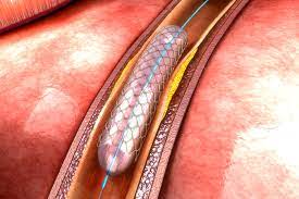 Angioplastie
